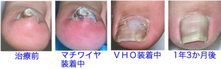 巻き爪矯正 VHOとマチワイヤの併用例