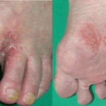 水虫の症状 写真1 水虫の症状 写真1
