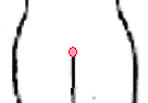 図１（とこずれの症状）