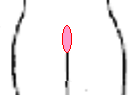 図２（とこずれの症状）